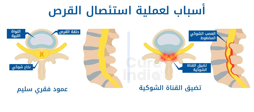 متى تكون عملية الديسك ضرورية